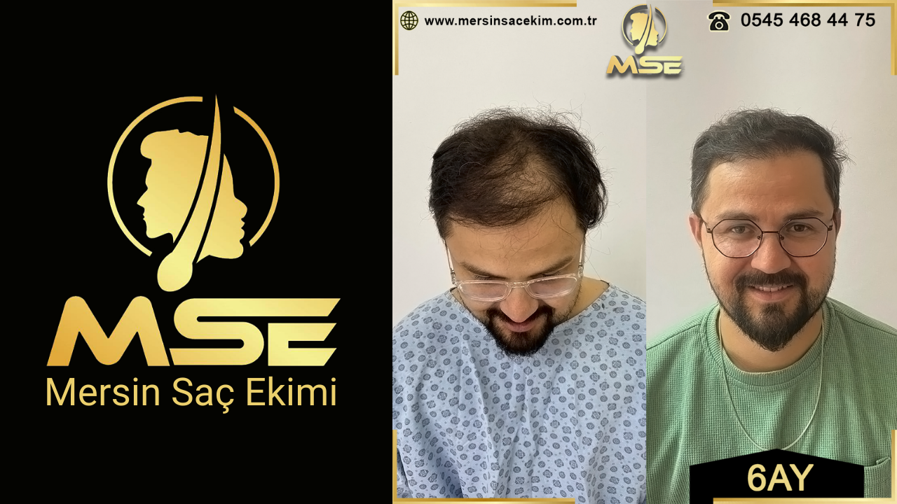 Mersin Saç Ekimi